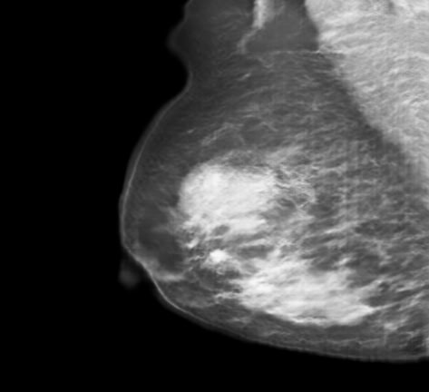 Nodule.jpg